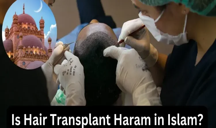 Is hair transplant permissible from Islamic point of view?